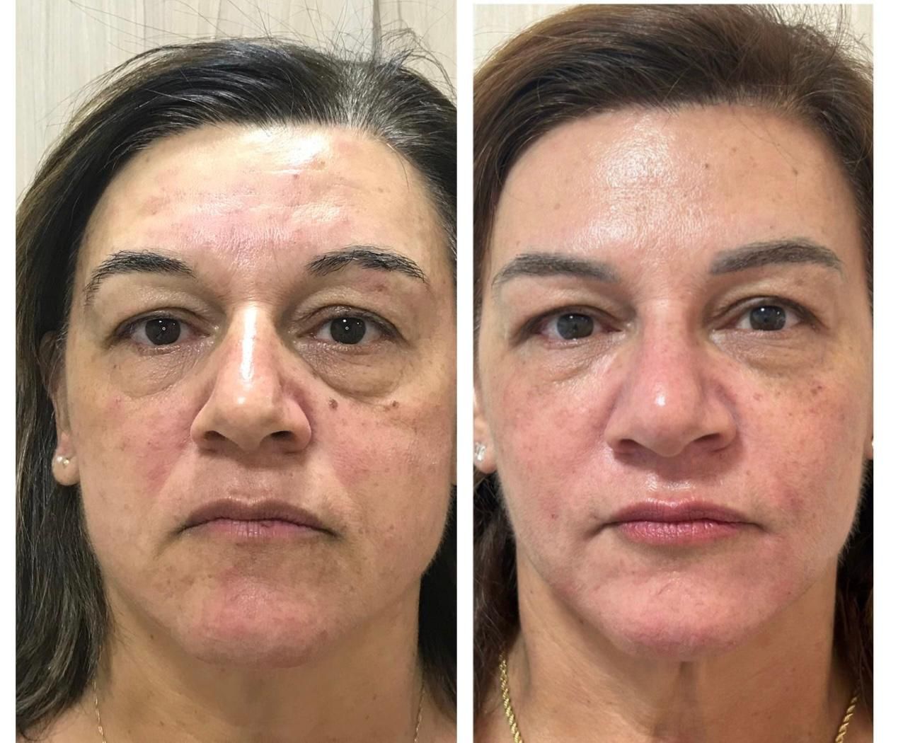 Comparativo de antes e depois de tratamento para a pele.