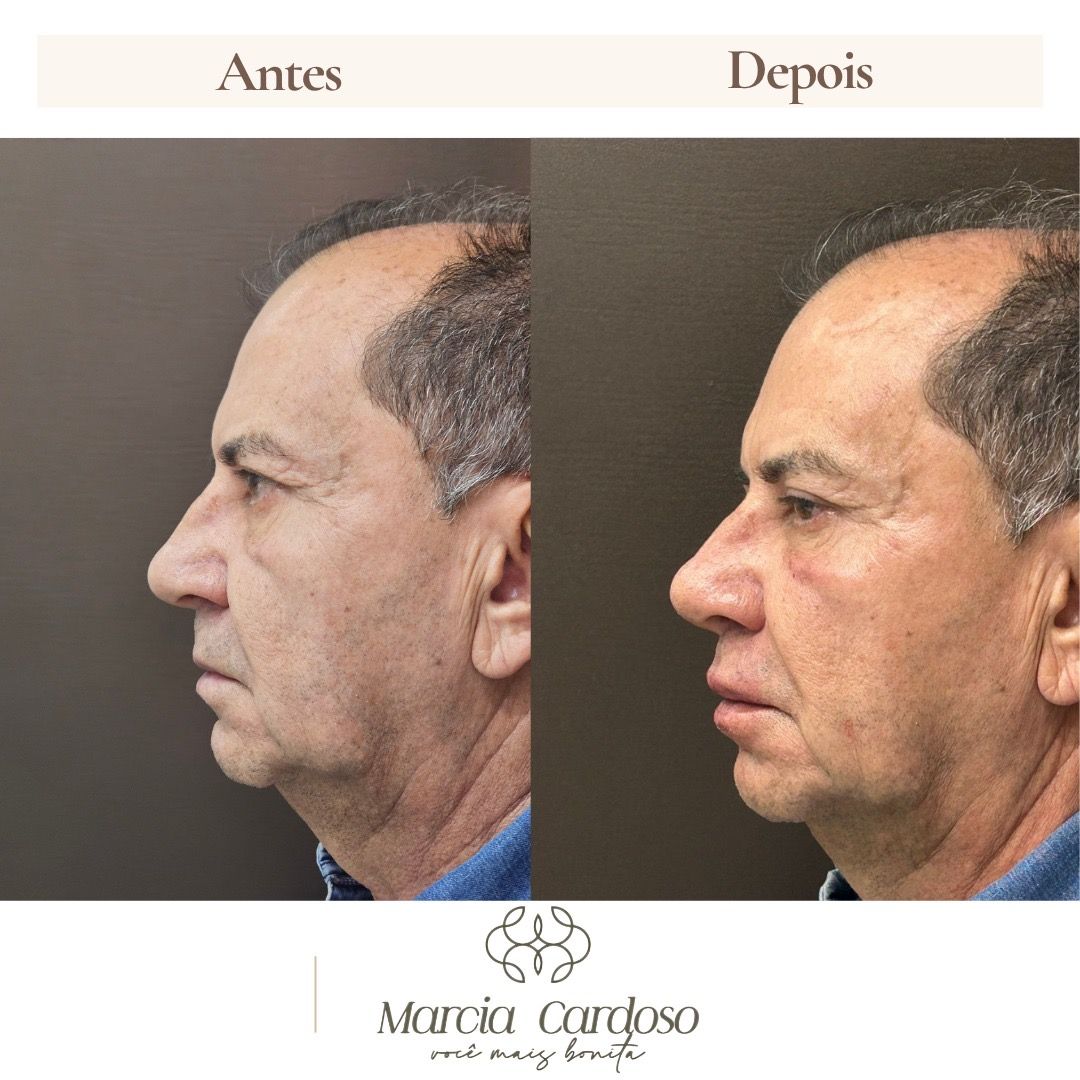Comparativo de perfil masculino antes e depois de procedimento estético.