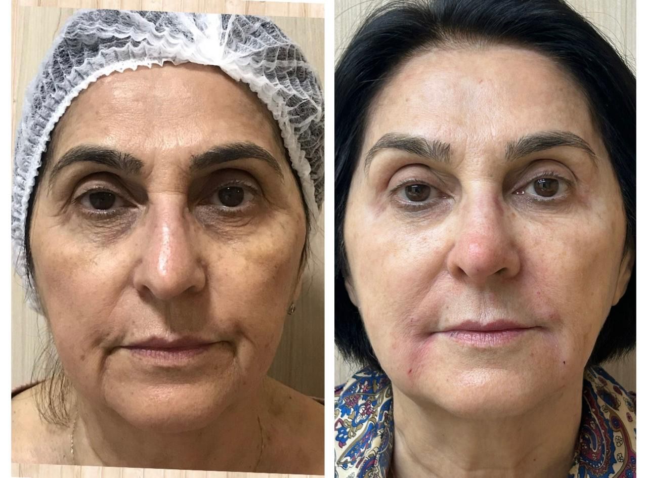 Comparativo de antes e depois em tratamento facial.